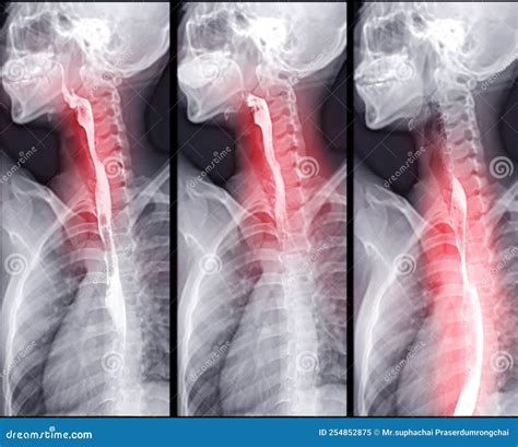 Normal Barium Swallow Anatomy