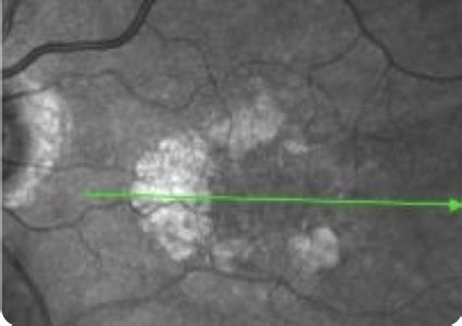 Geographic Atrophy How To Diagnose Ga When To Refer