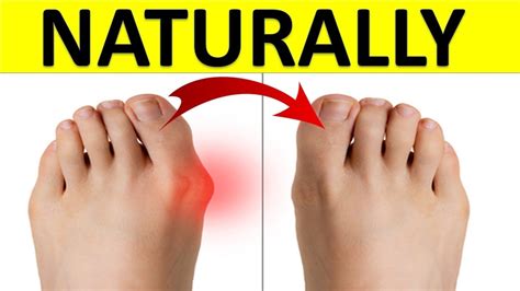 How To Get Rid Of Bunions Naturally With 8 Simple But Powerful Remedies