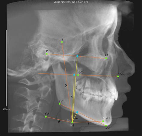 Figure 2 From Comparison Of Invisalign Mandibular Advancement And Twin Block On Upper Airway And