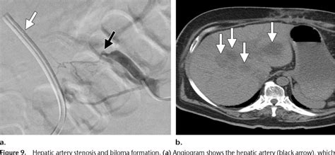 Figure 1 From Nonvascular Post Liver Transplantation Complications From Us Screening To Cross