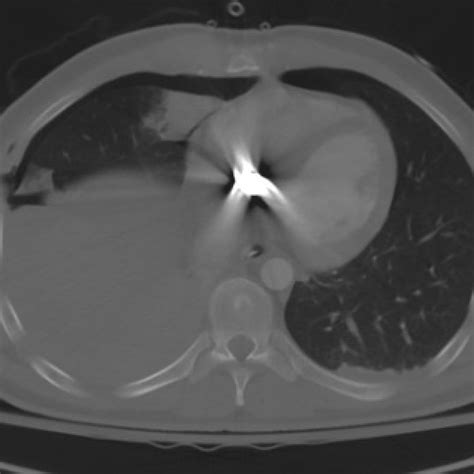 Chest X Ray Taken In The Trauma Bay Showing Bullet Shrapnel Overlying