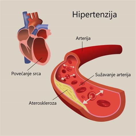 Esencijalna hipertenzija – što je, simptomi i liječenje | Zdravlje srca ...