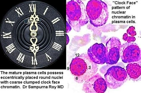 Clock Face Chromatin Pattern Of Plasma Cells In Plasmacytoma And