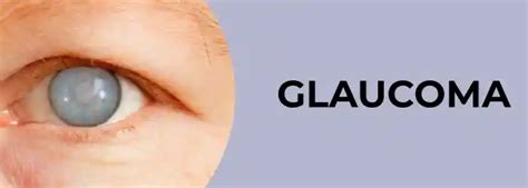 5 Important Factors To Consider Recognizing Glaucoma