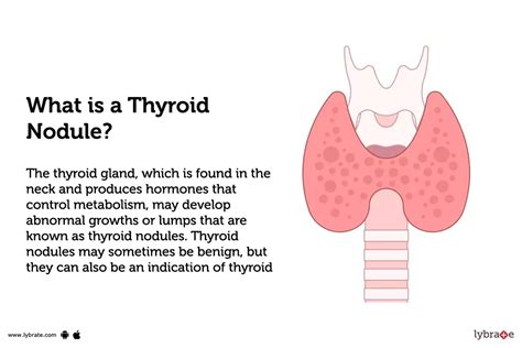 Thyroid Nodule Causes Symptoms Treatment And Cost