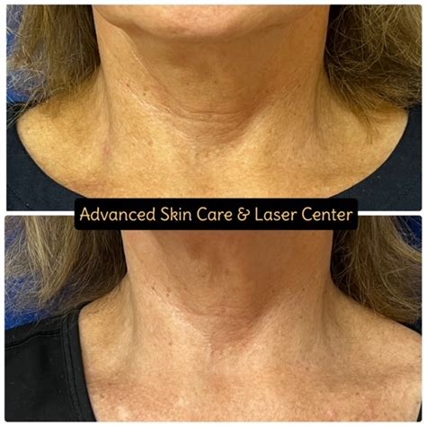 Morpheus8 Advanced Skin Care Laser And Body Contouring Center