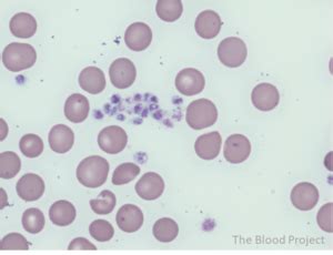 Platelet Clumping • The Blood Project