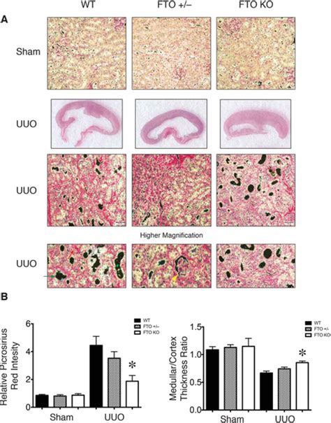 Fto Deficiency Attenuated Renal Fibrosis And Extracellular Matrix