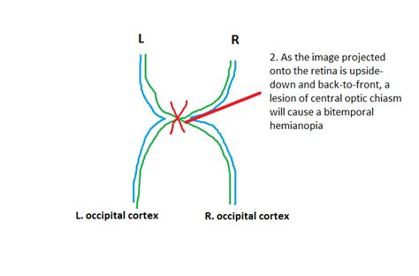 Homonymous Hemianopia Bitemporal Hemianopia Barts Wiki