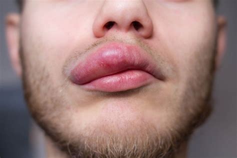 Angioedema hereditário o que é sintomas causas e tratamento Tua Saúde