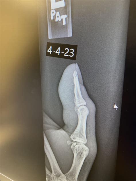 Broken thumb : r/Radiology