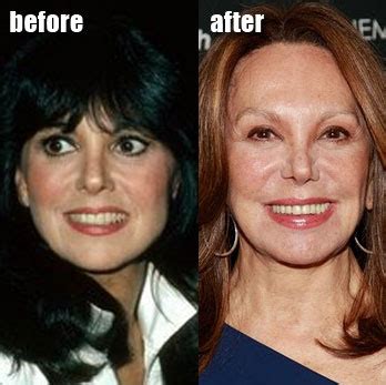 Marlo Thomas Plastic Surgery Before and After Facelift - Star Plastic ...