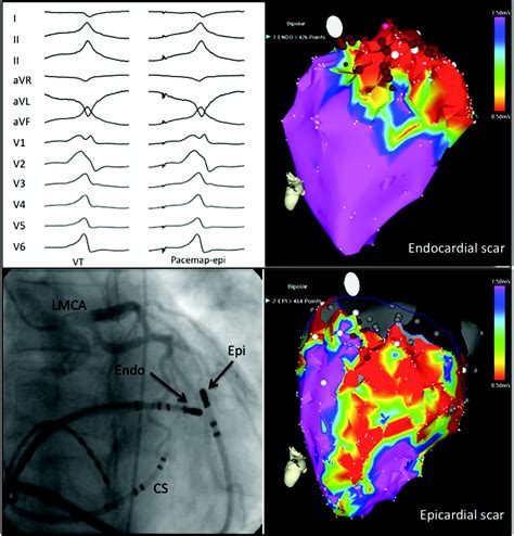 Catheter Ablation Of Ventricular Tachycardia Skill Versus Technology Hot Sex Picture