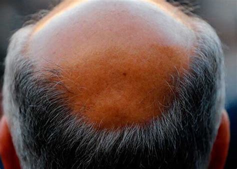 Descubre el Nuevo Tratamiento Revolucionario para la Alopecia Cirugía