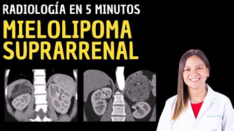 Radiolog A En Minutos Mielolipoma Suprarrenal Youtube