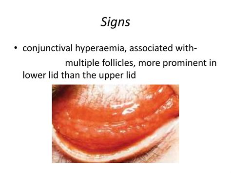 Viral And Bacterial Conjunctivitis Ppt