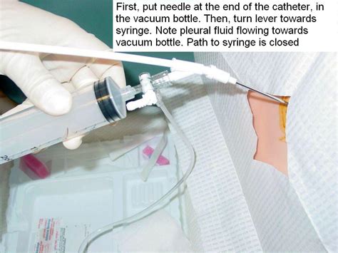 Clinical Notes: Thoracentesis: A Step-by-Step Procedure Guide with Photos