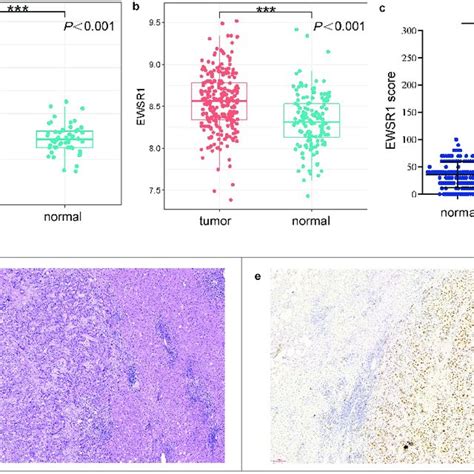 Ewsr Expression Between Tumor And Non Tumor Liver Tissues In Hcc