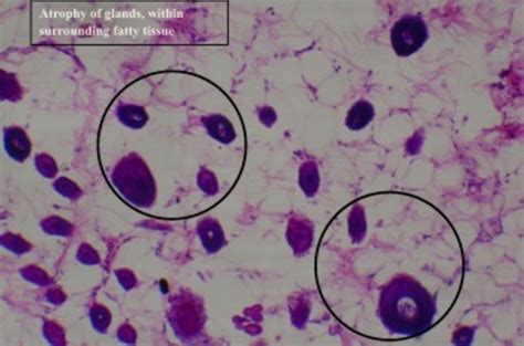 Histological Section Of The Breast Tissue Of DMBA Induced Breast Cancer