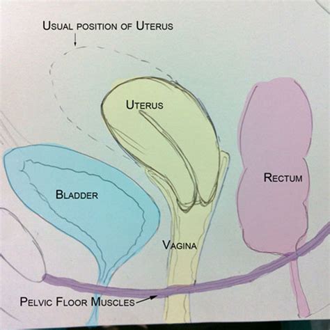 Cystocele Diagram - Wiring Diagram Pictures