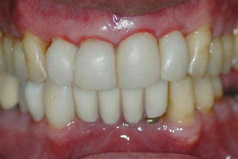 Gallery For Early Periodontitis Home Treatment