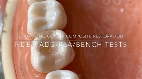 Should My Composite Restorations Last Forever Why Are They Failing At