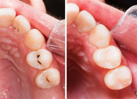 Guía Obturación Y Reconstrucción Abaden Dentistas