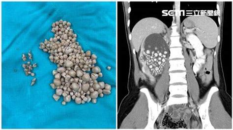 20歲女手搖飲當水喝！她腰部劇痛掛急診 檢查驚見腎臟「300顆結石」 三立新聞網 Line Today