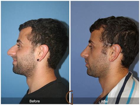 Rhinoplasty In Newport Beach CA Nose Job Dr Kevin Sadati