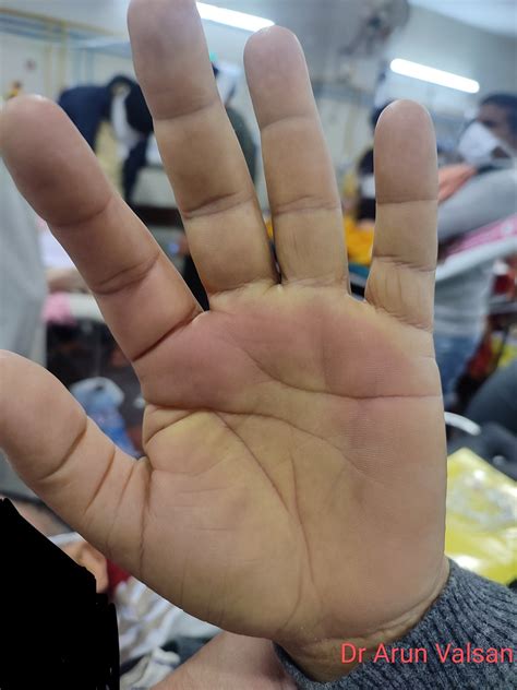 🔴 Hepatology Bedside Pearls Palmar Erythema Or Dawson Sign Of Advanced Liver Disease Central