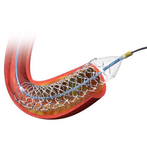 Coronary Stent BIOMATRIX NEOFLEX Biosensors International