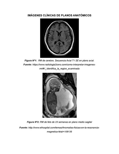 Rm De Cerebro Secuencia Axial T Se En Plano Axial Fuente Studocu