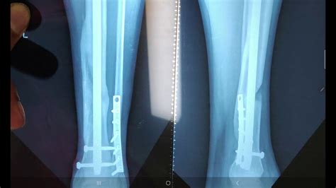 Post Tibia And Fibula Fracture X Ray Analysis And Bone Growth Stage By