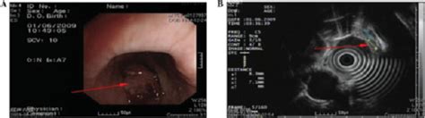 Diagnosis Kanker Esofagus Alomedika