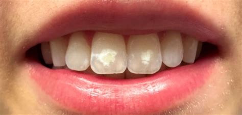 Icon Resin Infiltration Tinley Park Il Icon White Spot Treatment