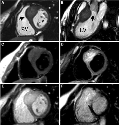 Cardiac Rhabdomyoma In An Adult With A Previous Presumptive Diagnosis