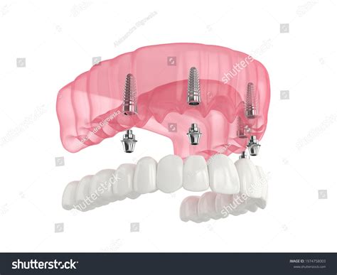 D Render Mandibular Prosthesis All On Stock Illustration