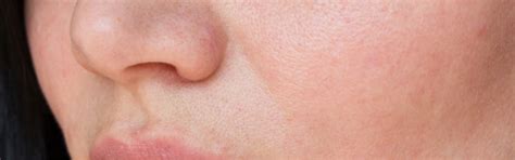 Redness & Blotchy Skin: Definitions & Treatments - GJK HealthPharma ...