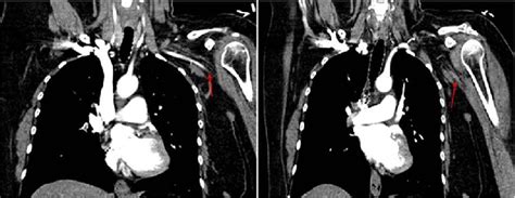 Occlusion of the axillary artery in the left upper limb. | Download ...