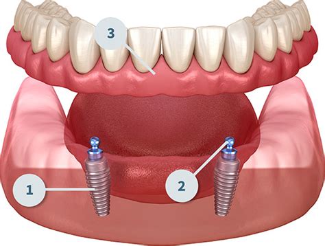 Implant Supported Dentures Process Benefits Care Off