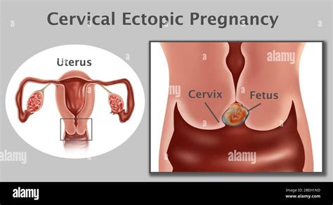 Embarazo Ectópico Cervical Fotografía De Stock Alamy