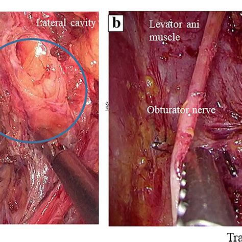 Comparison Of The Transanal And Transabdominal Views In The Deepest