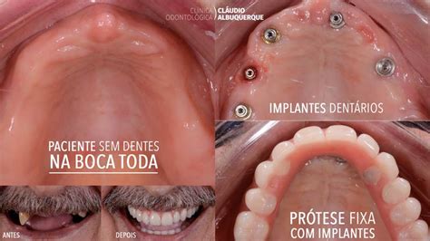 Implante Dent Rio Na Boca Toda Implantes De Dentes Em Todos Os Dentes