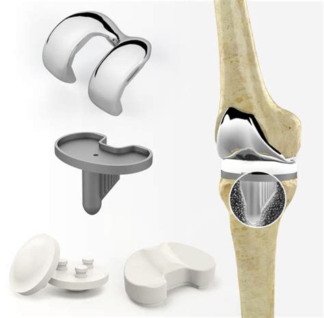 Three Compartment Knee Prosthesis Zimed Medical Sliding Cruciate