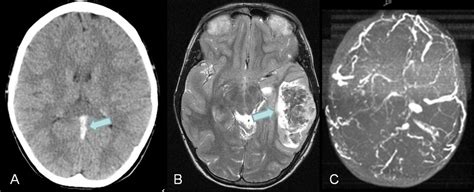 Cerebral Venous Thrombosisischemia Dermatology Advisor