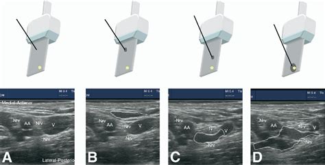 Figure From Controlling Needle Tip Progression During Ultrasound