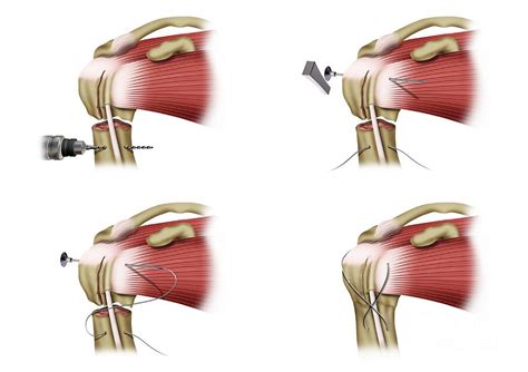 Cerclage Wiring In Shoulder Fracture Surgery Photograph by Maurizio De Angelis/science Photo Library