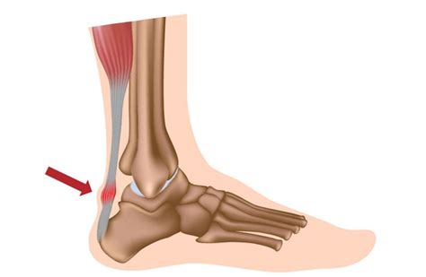 Ruptura Del Tendon De Aquiles Cirugia De Columna En Matamoros