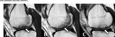 Figure 1 From Osteochondritis Dissecans Treated With Autograft Cartilage Transplantation System